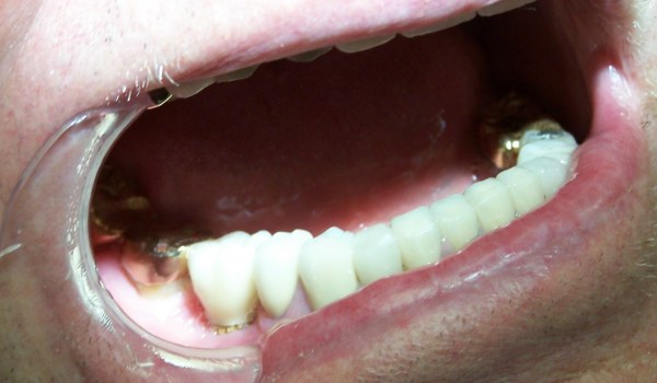 Idaho Falls Dentist - patient after dental implant