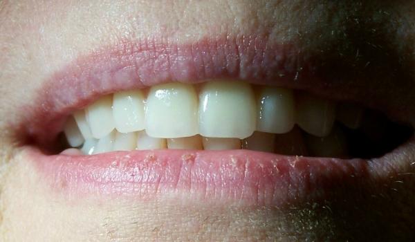 Idaho Falls Dentist - patient after dentures